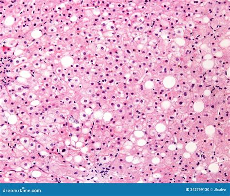 Human liver. Steatosis stock photo. Image of photomicrograph - 242799130