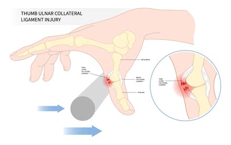 The Metacarpophalangeal Joint - Ligaments - TeachMeAnatomy