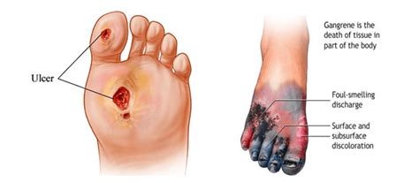 Critical Limb Ischemia | Washington Vascular