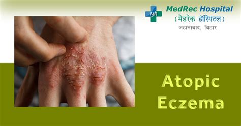 Atopic Eczema: Causes, Symptoms and Treatment Options