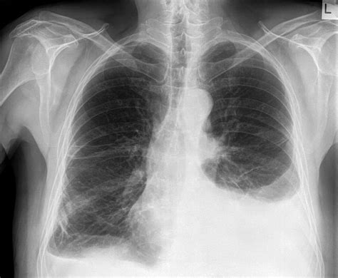 Lung Cancer Pleural Effusion