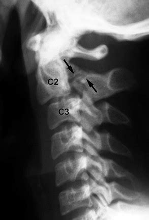 Hangman’s Fracture | Radiology Key