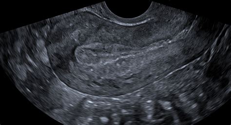 normal abdominal ct