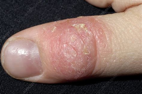 Eczema affecting the thumb - Stock Image - M150/0362 - Science Photo Library