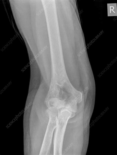 Fractured elbow, X-ray - Stock Image - C056/4055 - Science Photo Library