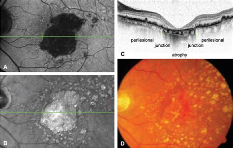 Figure 1 from High-resolution spectral domain-OCT imaging in geographic atrophy associated with ...