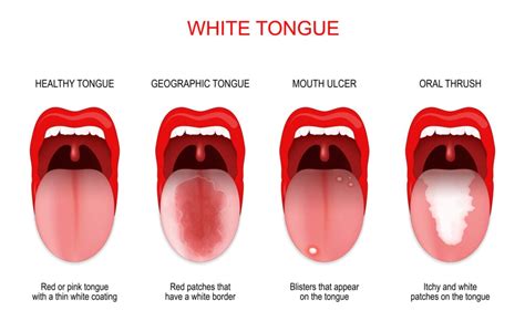 White Spots on Tongue: 7 Causes and How to Treat Them