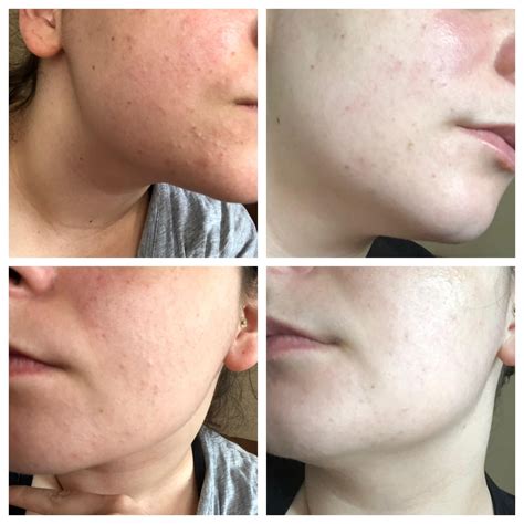 [B&A] 5 months of Epiduo Forte and having an actual skincare routine ...