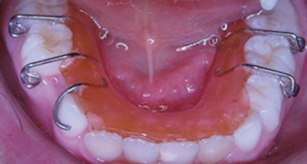 Space maintainers in dentistry | News | Dentagama