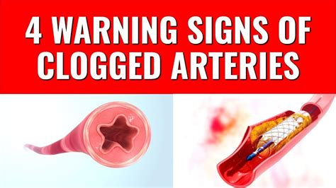 4 Warning Signs of Clogged Arteries | Clogged arteries, Warning signs, Arteries