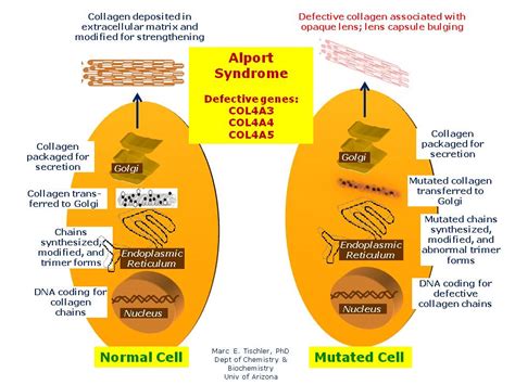 Alport Syndrome (Collagen IV-Related Nephropathies) | Hereditary Ocular ...