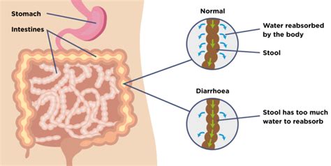 Colon Infection: Causes, Symptoms and Treatment | KnowInsiders