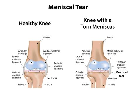 Ruptura de Menisc: Simptome, Tratament, Recuperare | Ortopedicum