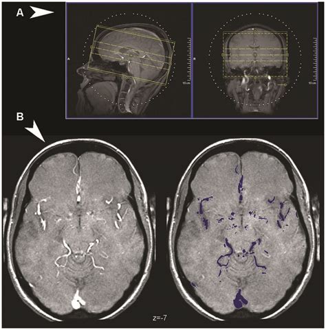 Frontiers | A Digital Atlas of Middle to Large Brain Vessels and Their Relation to Cortical and ...