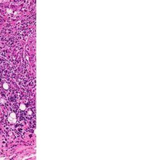 Omental and peritoneal biopsy results showing epithelioid granulomas... | Download Scientific ...