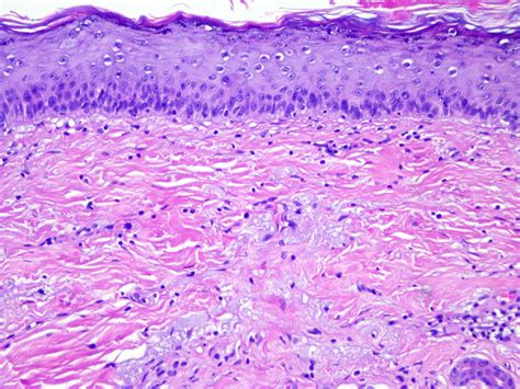 Pathology Outlines - Actinic keratosis