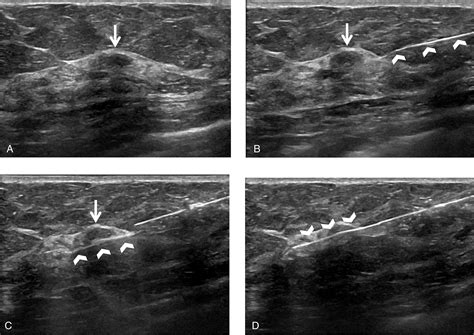 Ultrasound‐Guided Breast Biopsies - Bhatt - 2021 - Journal of ...