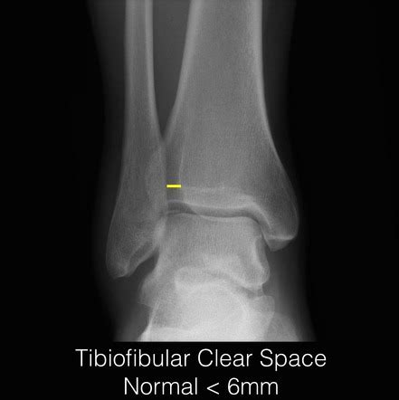 Tibiofibular clear space | Radiology Reference Article | Radiopaedia.org