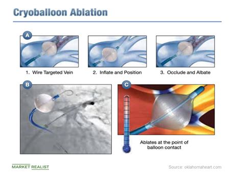 Assessing BSX’s Recently Acquired Cryterion Cryoablation Platform