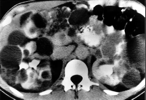 File:Polycystic VHL simulating autosomal dominant polycystic kidney disease.jpg - Wikipedia