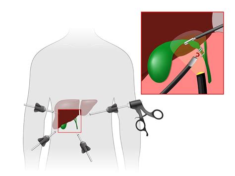 laparoscopic cholecystectomy with cholangiogram - Captions Couples