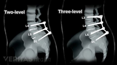 Spondylolisthesis Surgery Scar