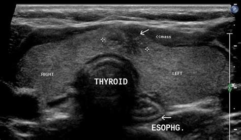 long rt thyroid on ultrasound - Google Search | Thyroid ultrasound ...