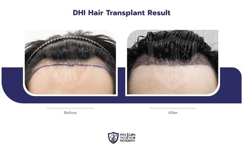 DHI Hair Transplant - Pavicon Mediness Center