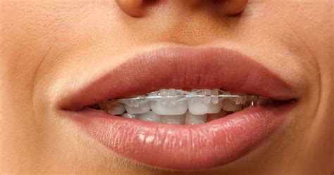 Overbite & Underbite Treatment Las Vegas - Nevada Dentistry & Braces