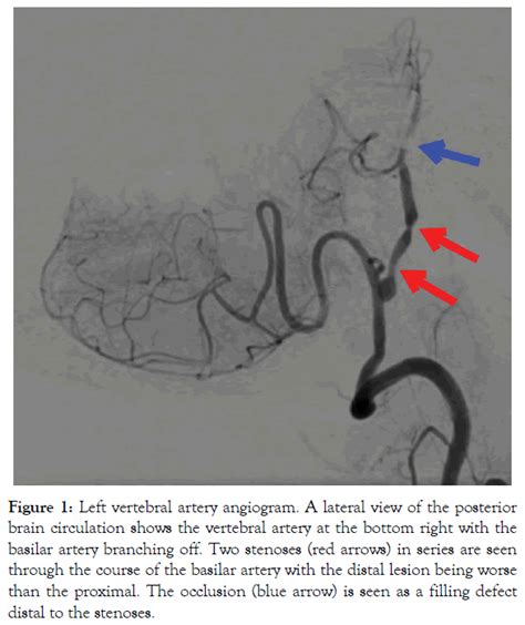 Rotational Vertebrobasilar Insufficiency Provoked By Distorted ...