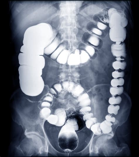 Barium enema - Healthily