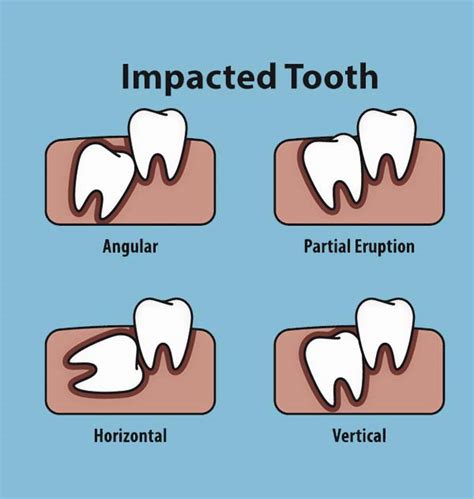 Wisdom Tooth Extraction Cost in Malaysia (2023) - Dental Clinic