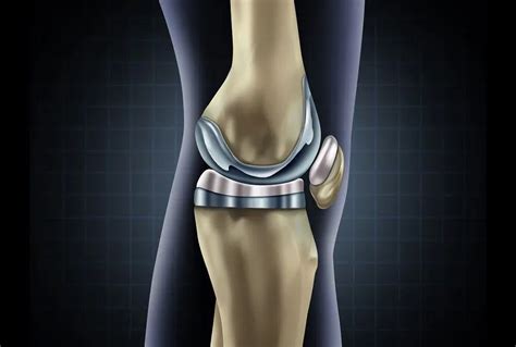 Everything You Need to Know about Total Knee Replacement (Arthroplasty ...