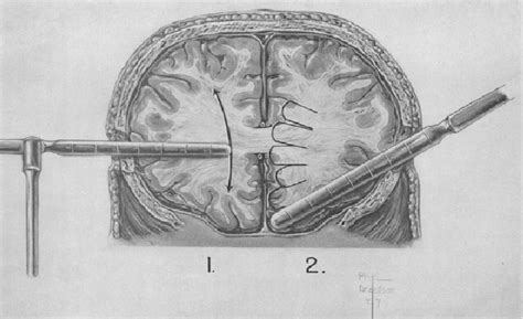 Figure 2 from A portrait of prefrontal lobotomy performed at the Royal Prince Alfred Hospital in ...