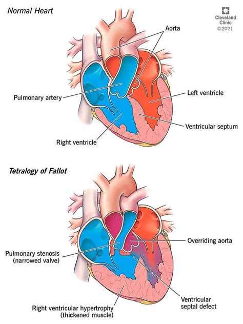 Tetralogy of Fallot: Symptoms, Treatment & Outlook