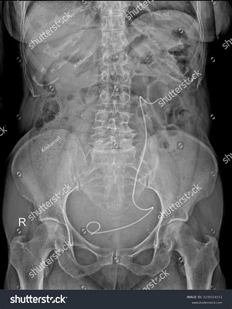 Kub Xray Showing Dj Stent Left Stock Photo 2230314151 | Shutterstock