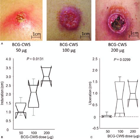 Local skin reactions at vaccine sites. A, Typical skin reactions... | Download Scientific Diagram