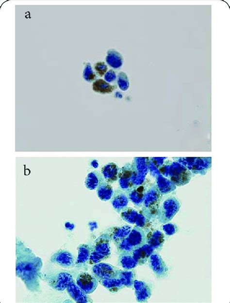 Urinary cytology (conventional smear) indicates the presence of... | Download Scientific Diagram