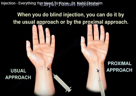 Carpal Tunnel Injection — OrthopaedicPrinciples.com