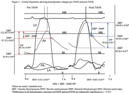 Abstract 17917: Effect of Transcatheter Aortic Valve Replacement (TAVR ...