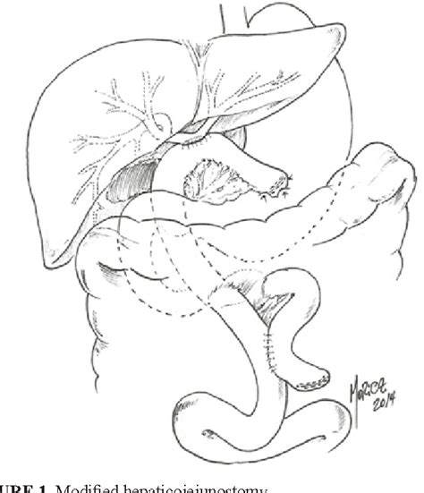 Figure 1 from Modified "Roux en Y" hepaticojejunostomy to permit ...