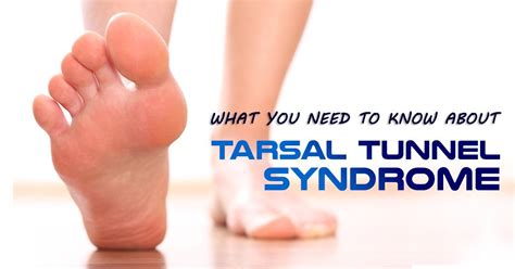 A nerve disorder affecting the posterior tibial nerve in your tarsal canal, Tarsal Tunnel ...