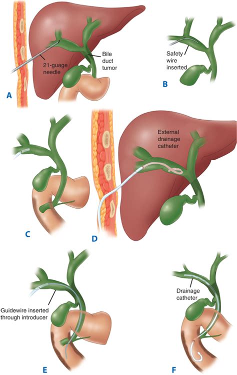 Percutaneous Transhepatic Drainage Of Gallbladder - Best Drain Photos ...