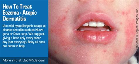 How To Treat Eczema - Atopic Dermatitis - Doc4Kids.com