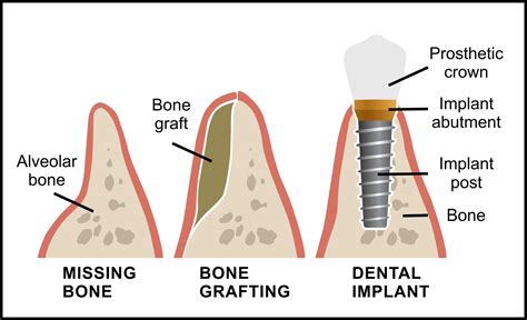 Bone Grafting for Dental Implants - Sherway Gardens Dental Centre