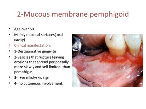 herpes oral ulcers