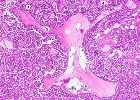 Pathology Outlines - Papillary thyroid carcinoma overview