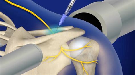 Suprascapular Nerve Block Iowa | Fluoroscopically Guided