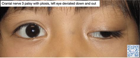 Cranial Nerve Palsy | 3rd nerve palsy | 4th nerve palsy | 6th nerve palsy