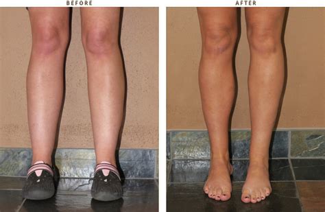 Calf Augmentation – Before and After Pictures * | Dr Turowski - Plastic ...